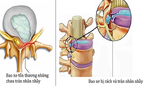 Rách bao xơ đĩa đệm có lành được không – Cách phục hồi và kiểm soát hiệu quả