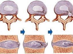 Rách vòng xơ đĩa đệm: nguyên nhân, triệu chứng và cách phục hồi tự nhiên