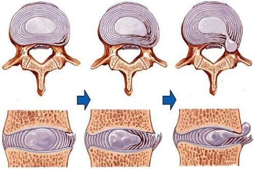 Rách vòng xơ đĩa đệm: nguyên nhân, triệu chứng và cách phục hồi tự nhiên