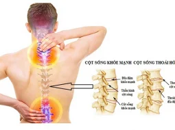 Các triệu chứng dễ nhận biết bệnh thoái hóa cột sống