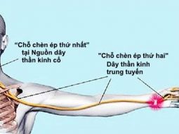 Cơ chế chèn dây thần kinh do biến chứng thoái hóa cột sống và các dây bị ảnh hưởng