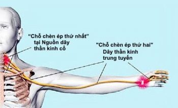 Cơ chế chèn dây thần kinh do biến chứng thoái hóa cột sống và các dây bị ảnh hưởng