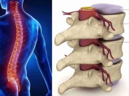 Thoái hóa cột sống thắt lưng có nguy hiểm không: Biến chứng và cách phòng ngừa