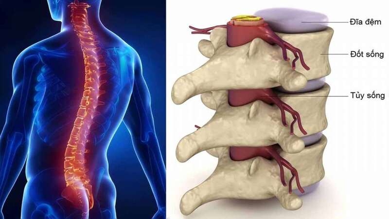 Thoái hóa cột sống thắt lưng có nguy hiểm không: Biến chứng và cách phòng ngừa