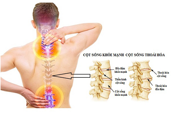 Thoái hóa cột sống