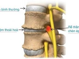 Thoái hóa đĩa đệm: nguyên nhân, triệu chứng và phương pháp điều trị