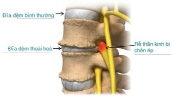 Nguyên nhân, biểu hiện sớm Thoái hóa đĩa đệm và hướng xử lý
