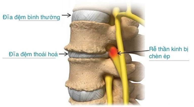 Thoái hóa đĩa đệm: nguyên nhân, triệu chứng và phương pháp điều trị