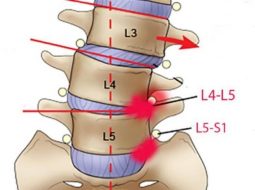 Thoái Hóa Đốt Sống L5 S1: Nguyên Nhân, Triệu Chứng & Giải Pháp Bền Vững