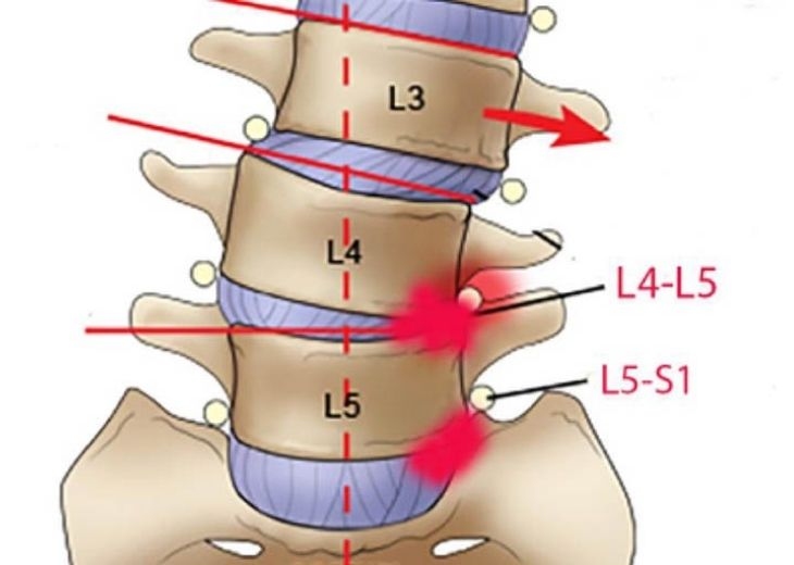 Thoái Hóa Đốt Sống L5 S1: Nguyên Nhân, Triệu Chứng & Giải Pháp Bền Vững