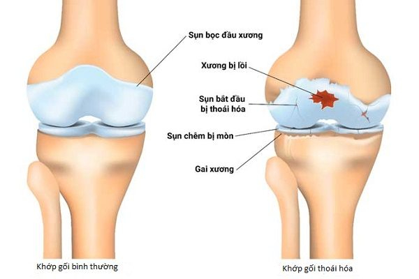 Thoái hóa khớp gối: Giải pháp an toàn hiệu quả từ y học cổ truyền