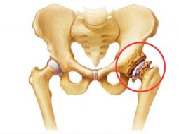 Thoái hóa khớp háng theo yhct: Nguyên nhân, triệu chứng, điều trị