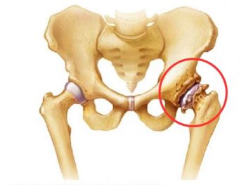 Nhận biết thoái hóa khớp háng và hướng khắc phục lâu dài