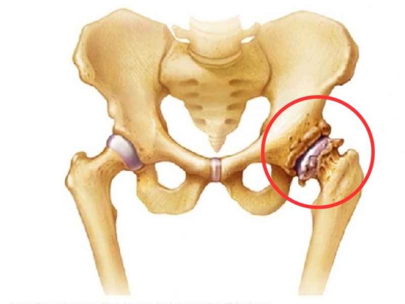 Thoái hóa khớp háng theo yhct: Nguyên nhân, triệu chứng, điều trị