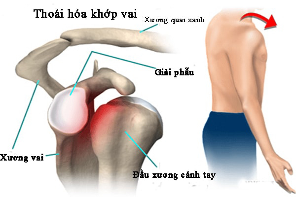 Thoái hóa khớp vai: triệu chứng, nguyên nhân và cách chăm sóc