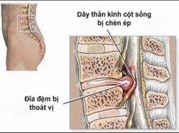 Thoát vị đĩa đệm chèn dây thần kinh – Cách chăm sóc và phục hồi