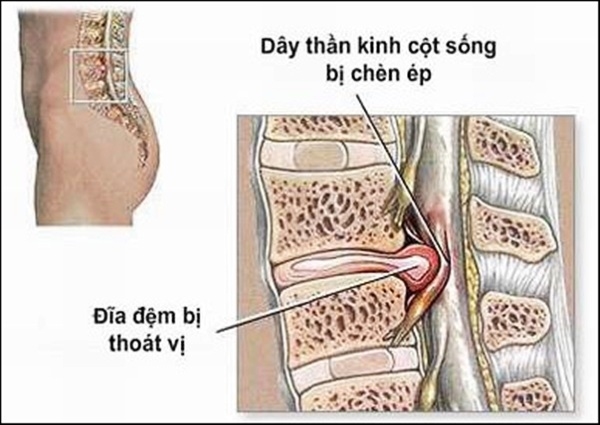 Thoát vị đĩa đệm chèn dây thần kinh – Cách chăm sóc và phục hồi