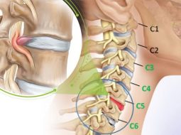 Thoát vị đĩa đệm cổ C5 C6: Triệu chứng, nguyên nhân & giải pháp bằng YHCT