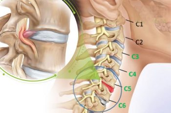 Thoát vị đĩa đệm cổ C5 C6: Triệu chứng, nguyên nhân & giải pháp bằng YHCT
