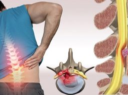 Thoát vị đĩa đệm có chữa được không? Phương pháp an toàn theo y học cổ truyền
