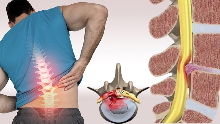 Thoát vị đĩa đệm có chữa được không? Phương pháp an toàn theo y học cổ truyền