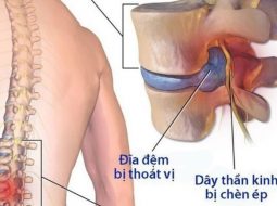 Thoát vị đĩa đệm cột sống thắt lưng: Phương pháp y học cổ truyền hiệu quả