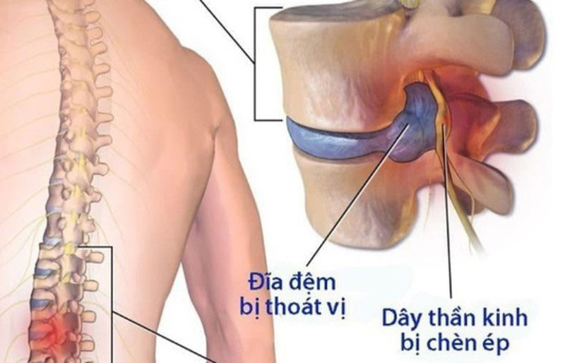 Thoát vị đĩa đệm cột sống thắt lưng: Phương pháp y học cổ truyền hiệu quả
