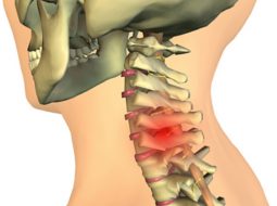 Thoát vị đĩa đệm cổ C3 C4: Nguyên nhân, triệu chứng và giải pháp hiệu quả