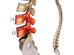 Thoát vị đĩa đệm L4 L5 – Nguyên nhân, điều trị qua y học cổ truyền & thảo dược