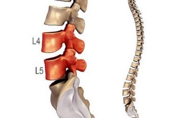 Dấu hiệu thoát vị đĩa đệm L4 L5 – Hướng hồi phục thần kinh hư tổn
