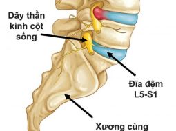 Thoát vị đĩa đệm L5 S1: Nguyên nhân, triệu chứng và cách điều trị bằng thảo dược