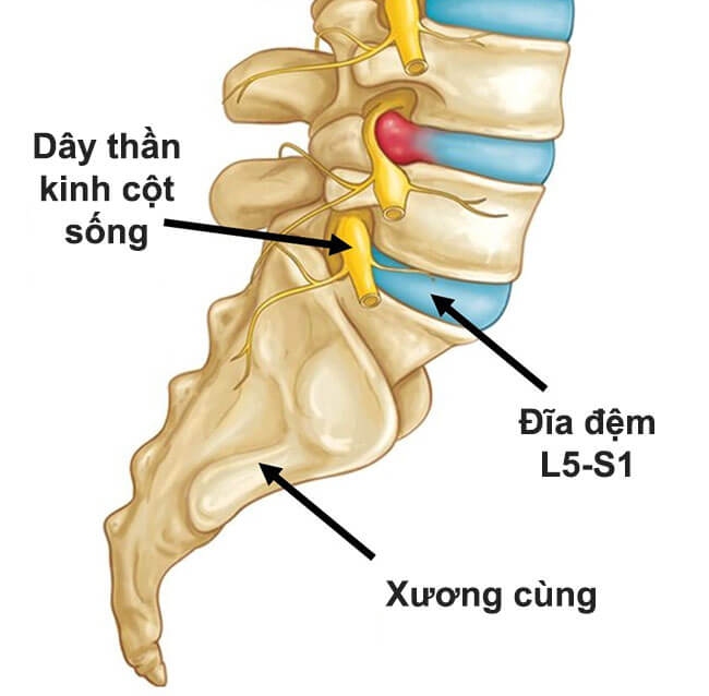 Thoát vị đĩa đệm L5 S1: Nguyên nhân, triệu chứng và cách điều trị bằng thảo dược