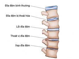 Xẹp đĩa đệm: nguyên nhân, triệu chứng & phương pháp tự nhiên
