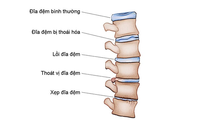 Xẹp đĩa đệm: nguyên nhân, triệu chứng & phương pháp tự nhiên