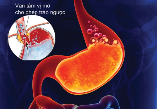 Trào ngược dạ dày
