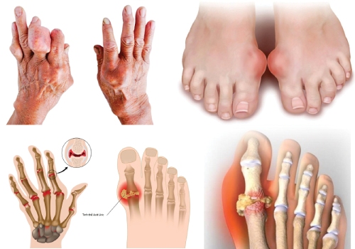 Bệnh Gout