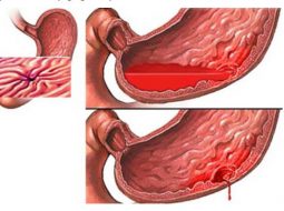 4 biến chứng nguy hiểm của bệnh dạ dày cần cẩn trọng!