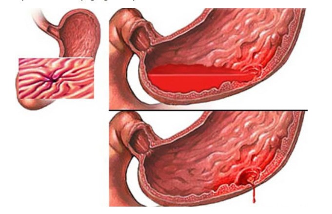 4 biến chứng nguy hiểm của bệnh dạ dày cần cẩn trọng!