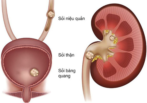 Sỏi thận