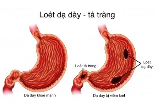 Viêm loét dạ dày