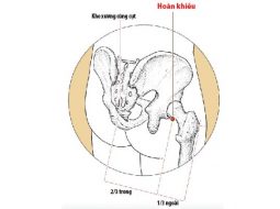 Huyệt Hoàn Khiêu giúp giảm đau vùng mông, hông, đùi