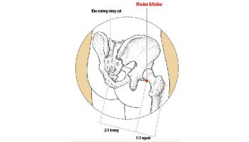 Huyệt Hoàn Khiêu giúp giảm đau vùng mông, hông, đùi