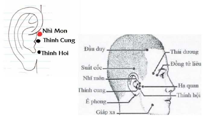 Huyệt Nhĩ Môn chủ trị các vấn đề thường gặp ở tai