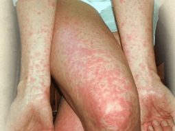 Nổi mề đay khắp người – Biểu hiện cảnh báo từ tạng phủ