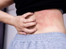 Nguyên nhân nổi mề đay sau sinh – Đông y khắc phục thế nào?