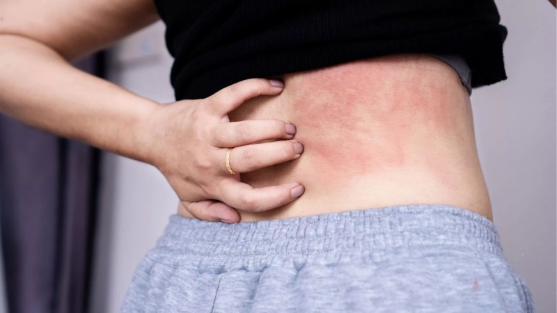 Nguyên nhân nổi mề đay sau sinh – Đông y khắc phục thế nào?