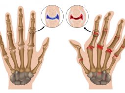 Thoái hóa khớp ngón tay – Đừng coi thường dấu hiệu nhỏ