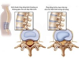 Nguyên nhân hẹp ống sống thắt lưng, dấu hiệu và cách cải thiện