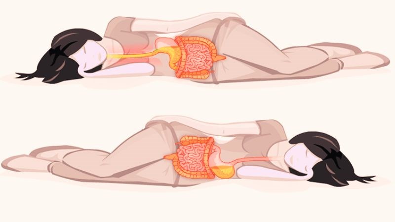 Trào ngược dạ dày nên nằm nghiêng bên nào cải thiện bệnh?