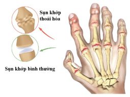 Nhận biết dấu hiệu thoái hóa khớp bàn tay và phòng ngừa cải thiện